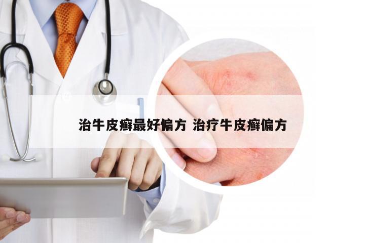 治牛皮癣最好偏方 治疗牛皮癣偏方