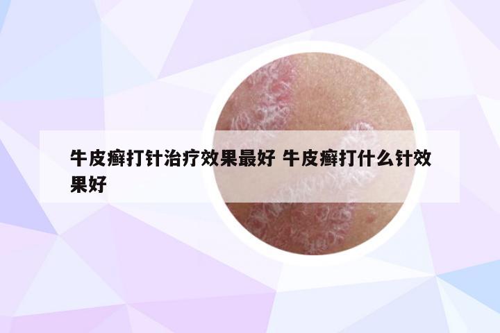 牛皮癣打针治疗效果最好 牛皮癣打什么针效果好