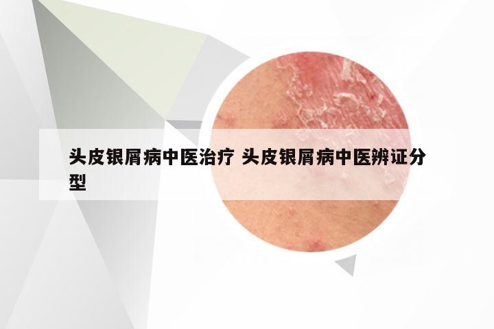 头皮银屑病中医治疗 头皮银屑病中医辨证分型