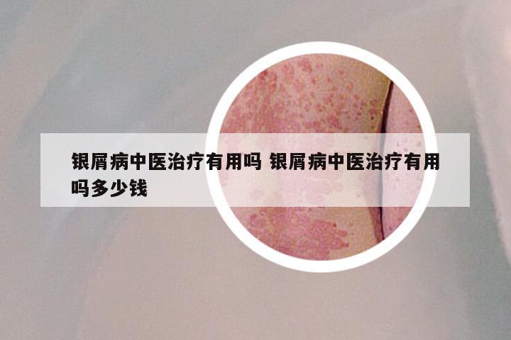 银屑病中医治疗有用吗 银屑病中医治疗有用吗多少钱