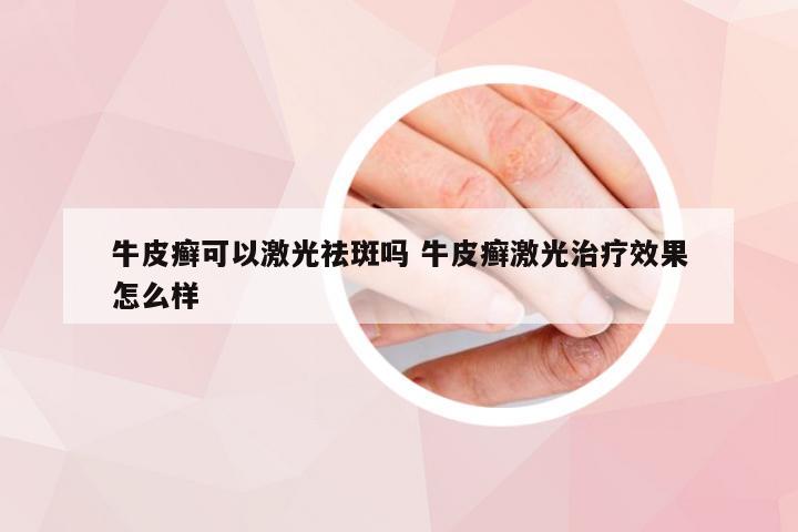牛皮癣可以激光祛斑吗 牛皮癣激光治疗效果怎么样