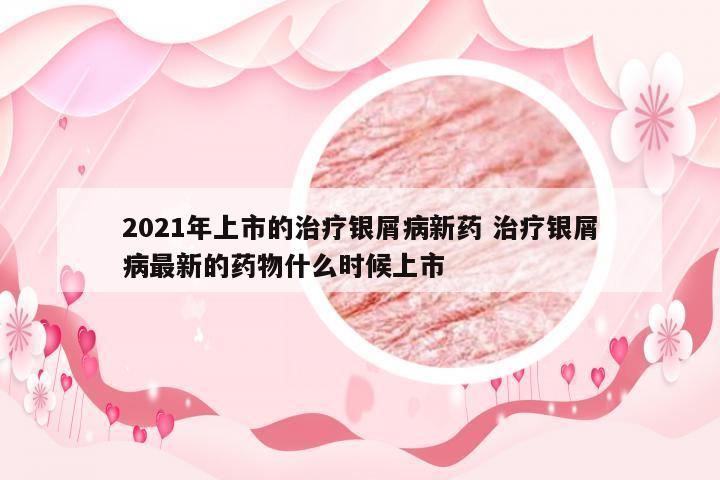 2021年上市的治疗银屑病新药 治疗银屑病最新的药物什么时候上市