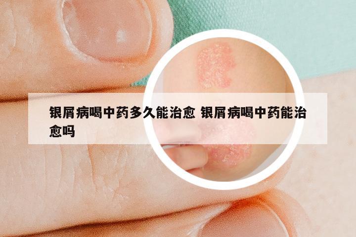 银屑病喝中药多久能治愈 银屑病喝中药能治愈吗