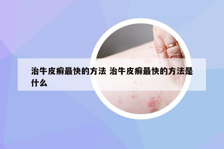 治牛皮癣最快的方法 治牛皮癣最快的方法是什么
