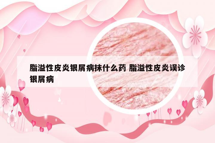脂溢性皮炎银屑病抹什么药 脂溢性皮炎误诊银屑病