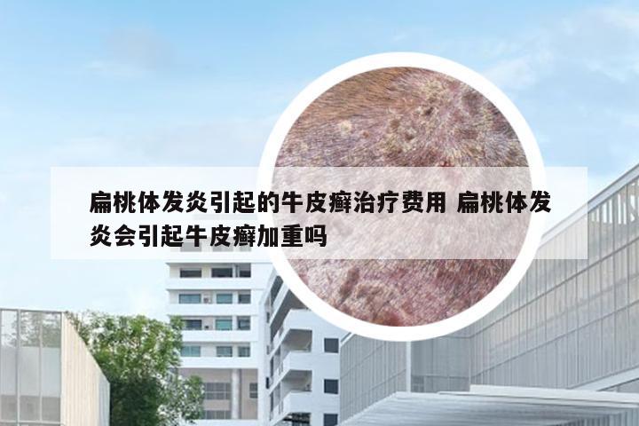扁桃体发炎引起的牛皮癣治疗费用 扁桃体发炎会引起牛皮癣加重吗