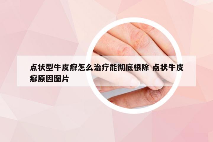 点状型牛皮癣怎么治疗能彻底根除 点状牛皮癣原因图片