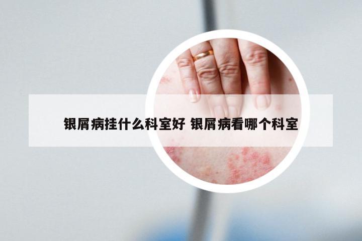 银屑病挂什么科室好 银屑病看哪个科室
