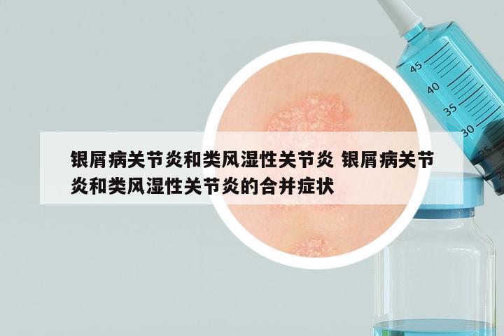 银屑病关节炎和类风湿性关节炎 银屑病关节炎和类风湿性关节炎的合并症状