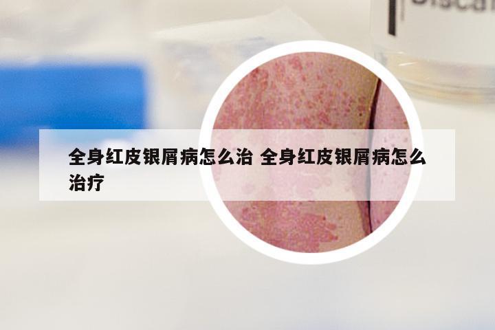 全身红皮银屑病怎么治 全身红皮银屑病怎么治疗