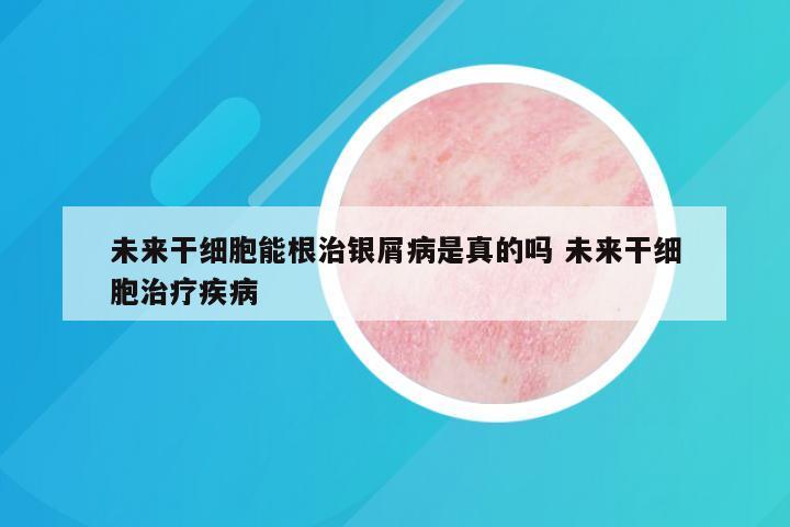 未来干细胞能根治银屑病是真的吗 未来干细胞治疗疾病