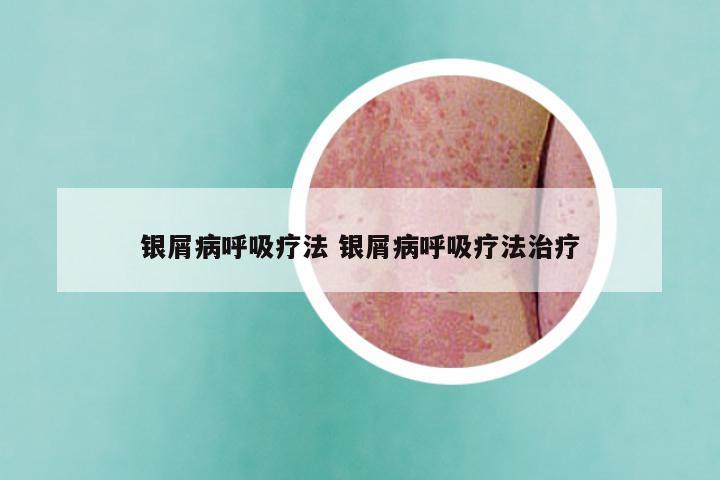 银屑病呼吸疗法 银屑病呼吸疗法治疗