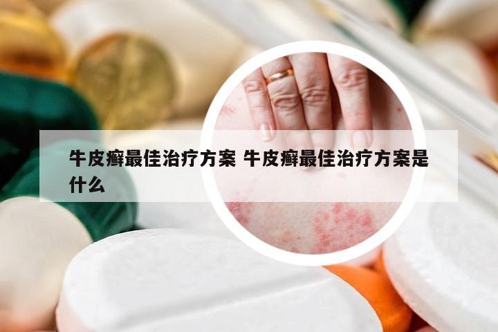 牛皮癣最佳治疗方案 牛皮癣最佳治疗方案是什么