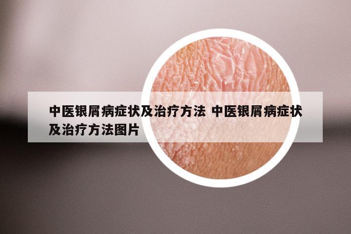 中医银屑病症状及治疗方法 中医银屑病症状及治疗方法图片