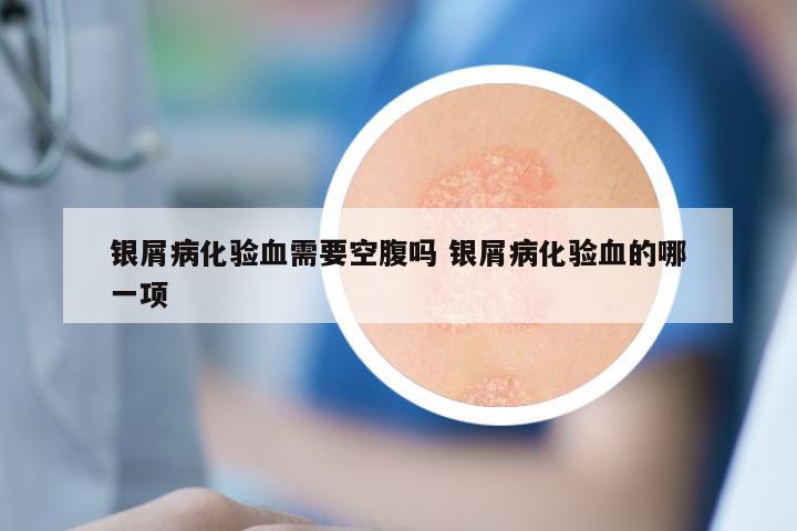 银屑病化验血需要空腹吗 银屑病化验血的哪一项