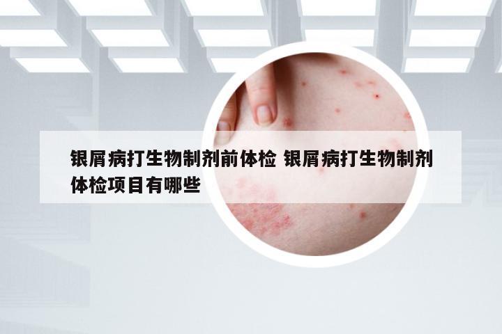 银屑病打生物制剂前体检 银屑病打生物制剂体检项目有哪些