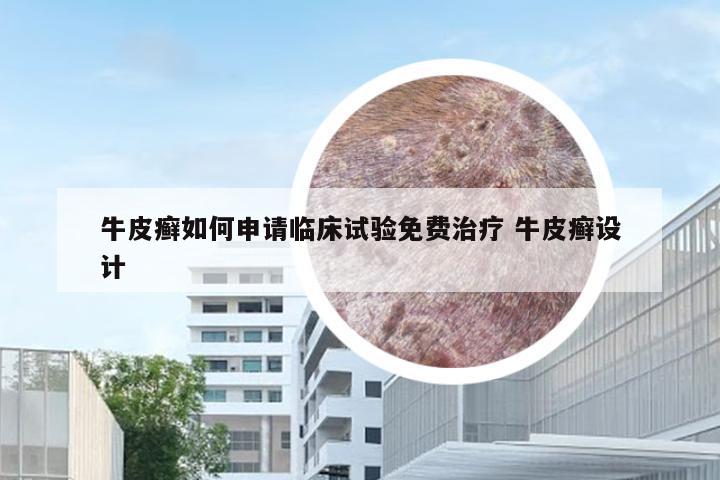 牛皮癣如何申请临床试验免费治疗 牛皮癣设计