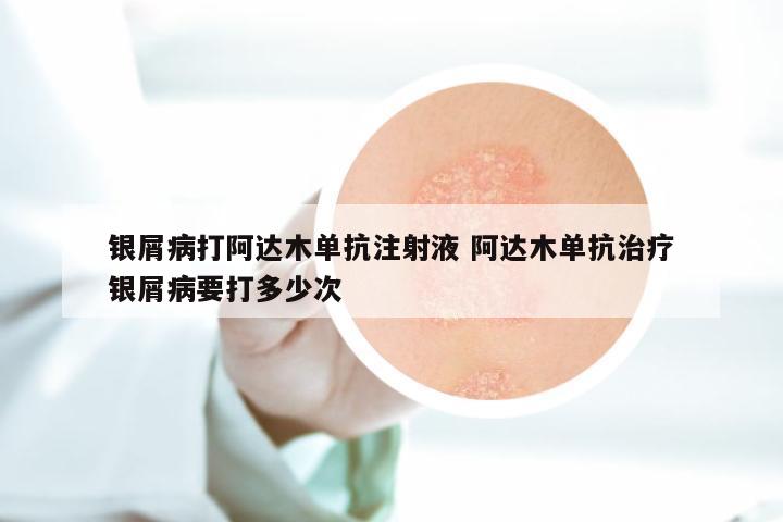 银屑病打阿达木单抗注射液 阿达木单抗治疗银屑病要打多少次