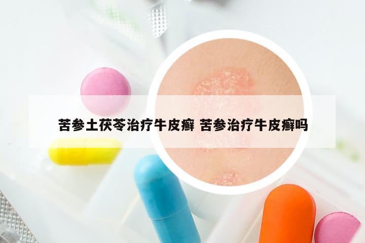 苦参土茯苓治疗牛皮癣 苦参治疗牛皮癣吗
