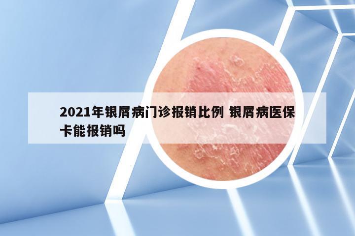 2021年银屑病门诊报销比例 银屑病医保卡能报销吗