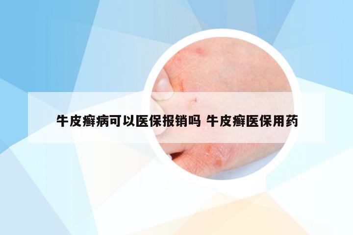 牛皮癣病可以医保报销吗 牛皮癣医保用药