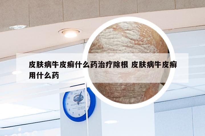皮肤病牛皮癣什么药治疗除根 皮肤病牛皮癣用什么药