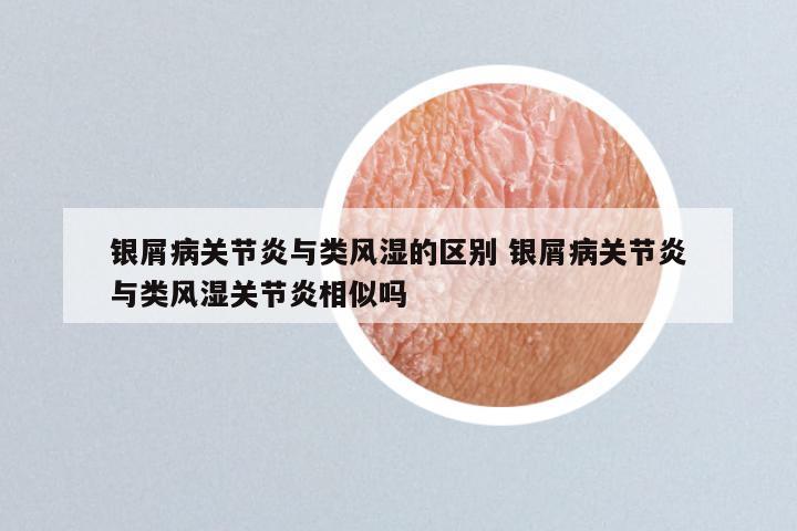 银屑病关节炎与类风湿的区别 银屑病关节炎与类风湿关节炎相似吗
