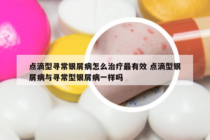 点滴型寻常银屑病怎么治疗最有效 点滴型银屑病与寻常型银屑病一样吗