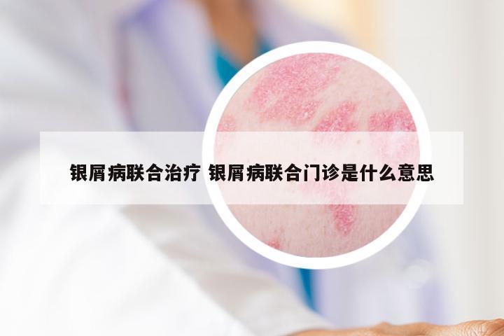 银屑病联合治疗 银屑病联合门诊是什么意思