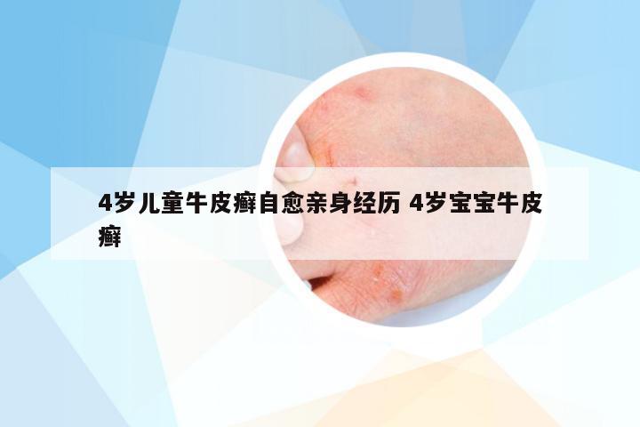 4岁儿童牛皮癣自愈亲身经历 4岁宝宝牛皮癣