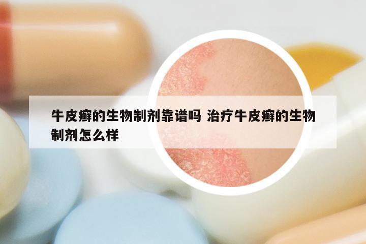 牛皮癣的生物制剂靠谱吗 治疗牛皮癣的生物制剂怎么样