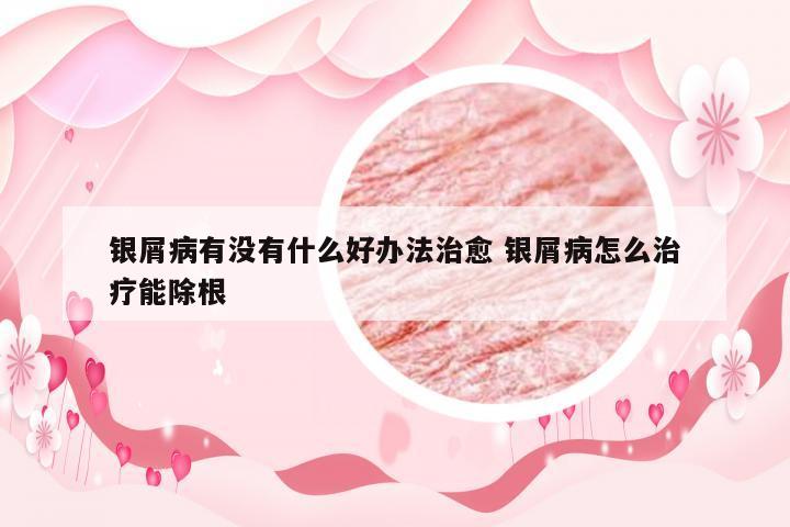 银屑病有没有什么好办法治愈 银屑病怎么治疗能除根