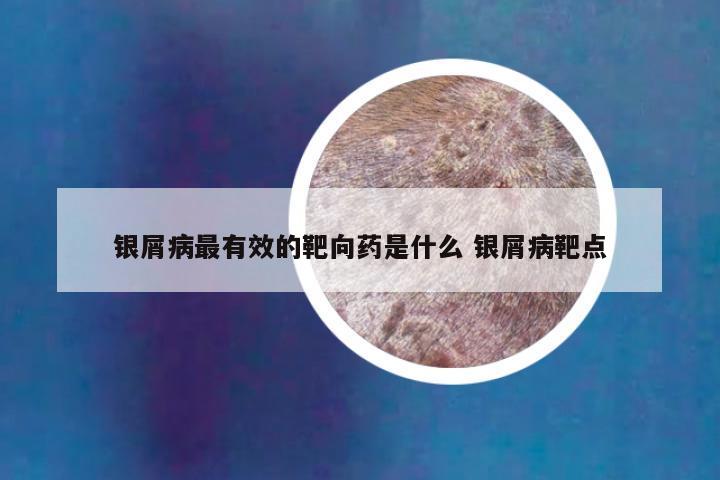 银屑病最有效的靶向药是什么 银屑病靶点