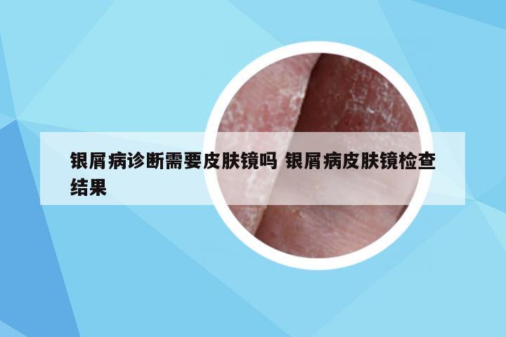 银屑病诊断需要皮肤镜吗 银屑病皮肤镜检查结果