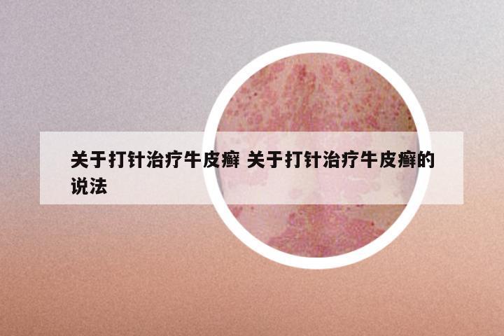 关于打针治疗牛皮癣 关于打针治疗牛皮癣的说法