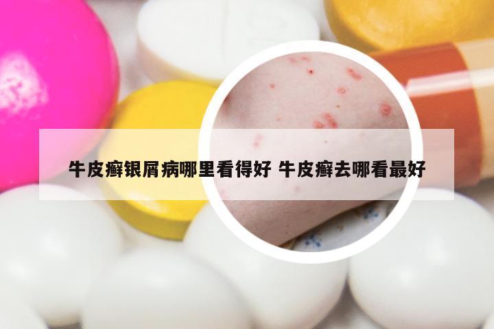 牛皮癣银屑病哪里看得好 牛皮癣去哪看最好