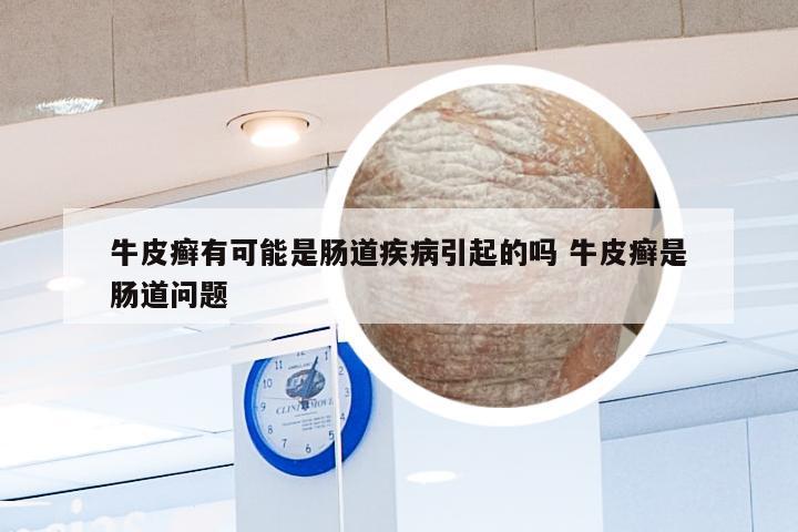牛皮癣有可能是肠道疾病引起的吗 牛皮癣是肠道问题