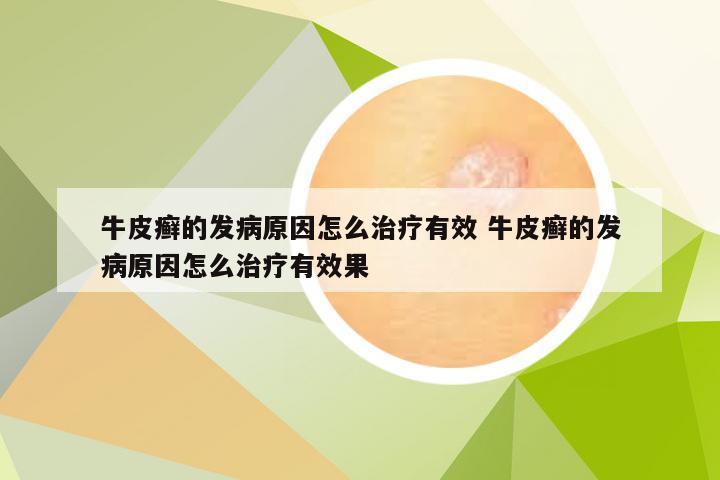 牛皮癣的发病原因怎么治疗有效 牛皮癣的发病原因怎么治疗有效果