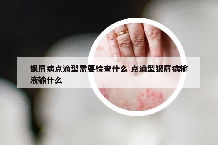银屑病点滴型需要检查什么 点滴型银屑病输液输什么