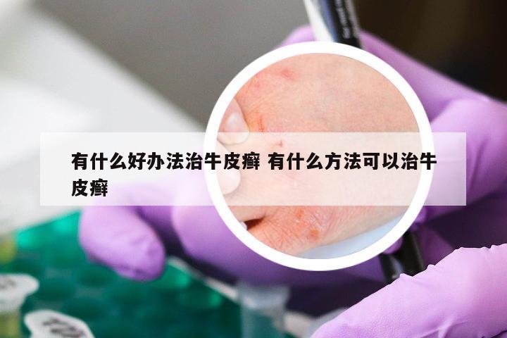有什么好办法治牛皮癣 有什么方法可以治牛皮癣
