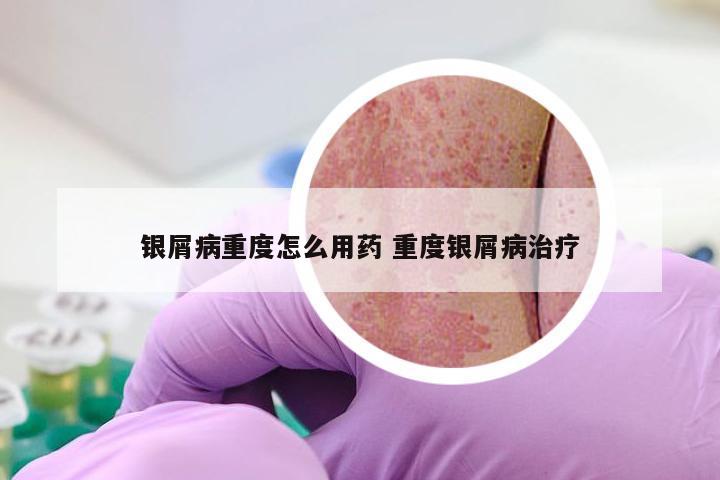 银屑病重度怎么用药 重度银屑病治疗