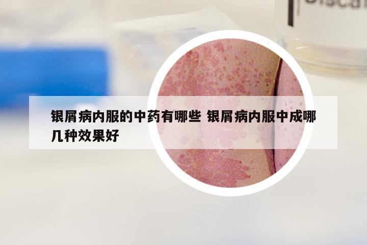 银屑病内服的中药有哪些 银屑病内服中成哪几种效果好