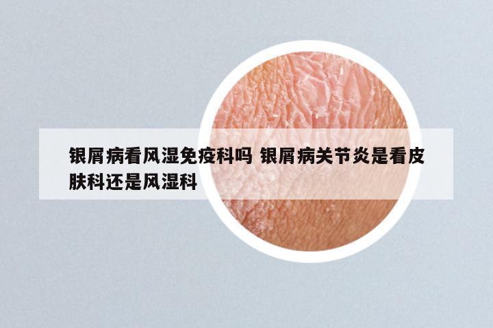 银屑病看风湿免疫科吗 银屑病关节炎是看皮肤科还是风湿科