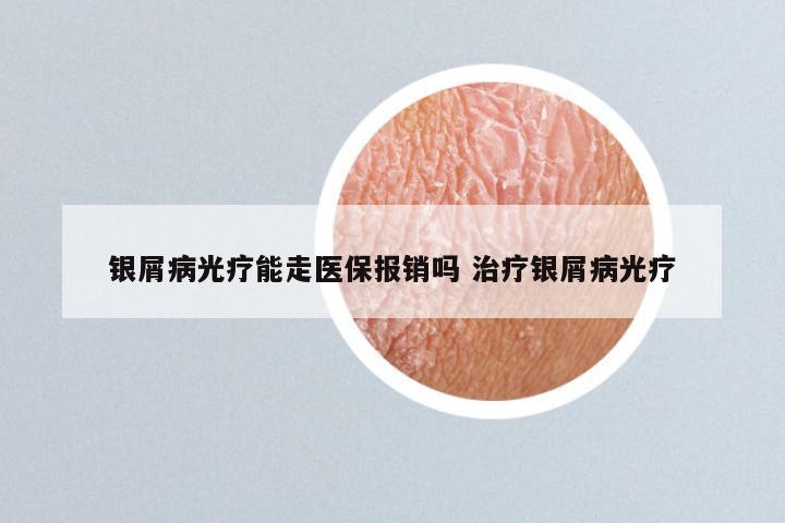 银屑病光疗能走医保报销吗 治疗银屑病光疗