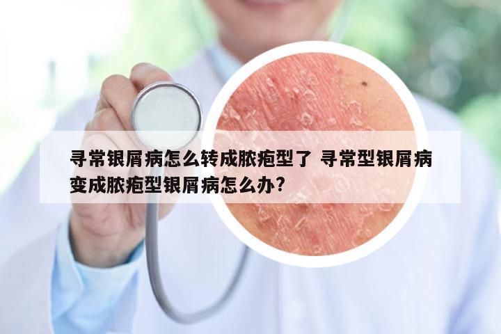 寻常银屑病怎么转成脓疱型了 寻常型银屑病变成脓疱型银屑病怎么办?