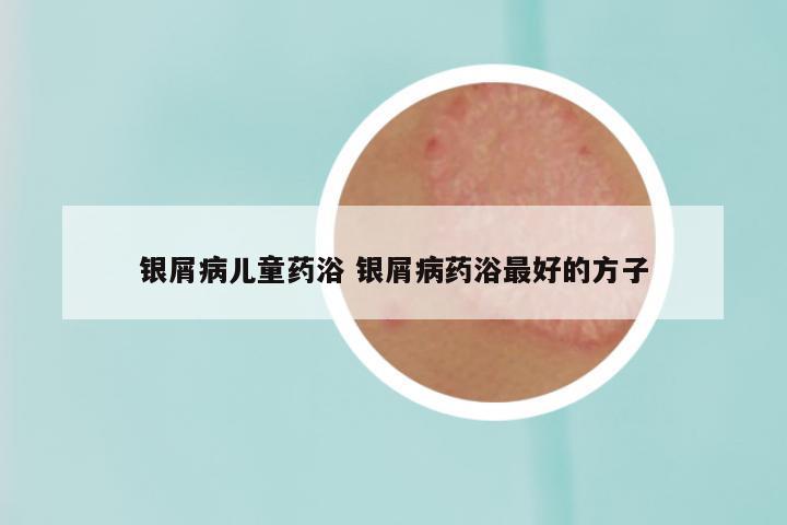 银屑病儿童药浴 银屑病药浴最好的方子