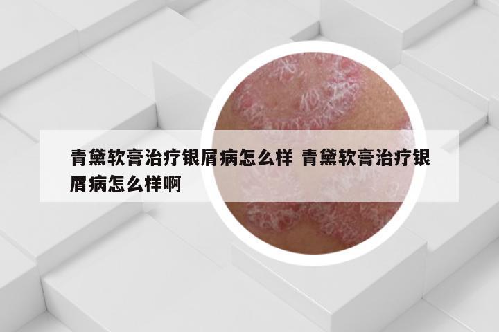 青黛软膏治疗银屑病怎么样 青黛软膏治疗银屑病怎么样啊