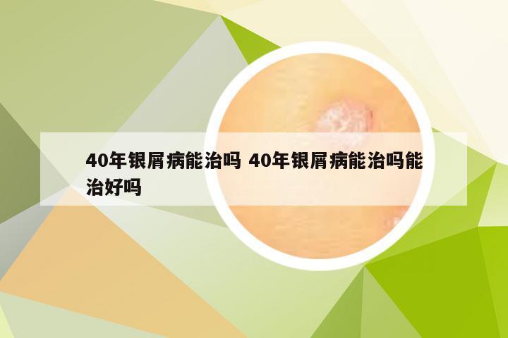 40年银屑病能治吗 40年银屑病能治吗能治好吗