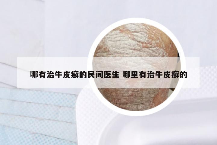 哪有治牛皮癣的民间医生 哪里有治牛皮癣的