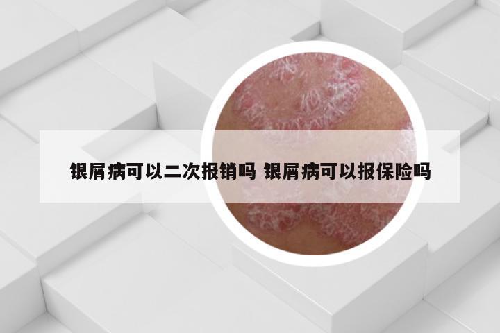 银屑病可以二次报销吗 银屑病可以报保险吗